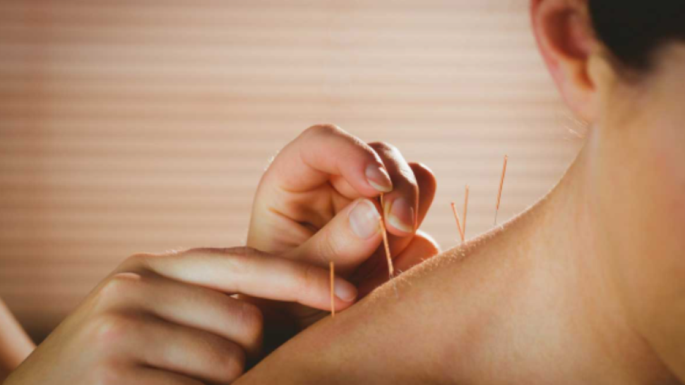 Une femme qui est se fait une séance d'acupuncture