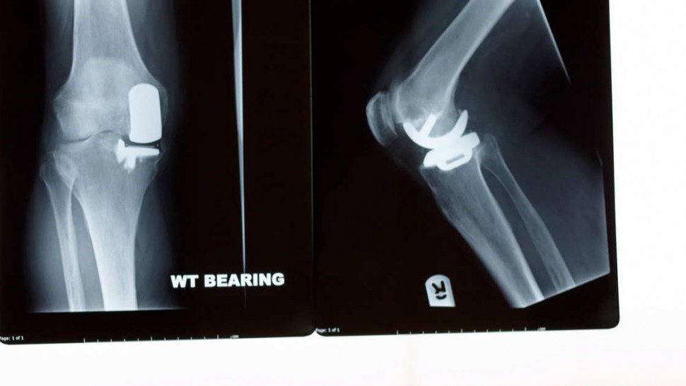 Photo d'une prothèse partielle de genou