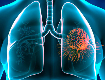 Image d'un cancer du poumon