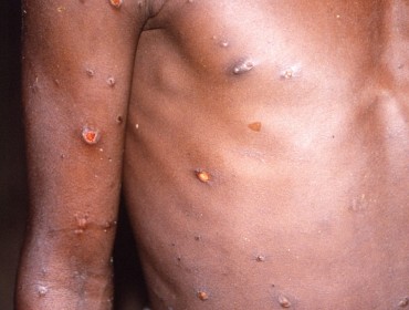 Torse d'un patient africain infecté par le virus de la variole du singe