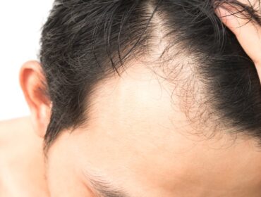 Comment ralentir la chute des cheveux ?