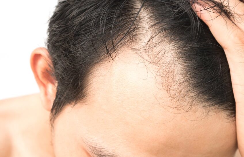 Comment ralentir la chute des cheveux ?