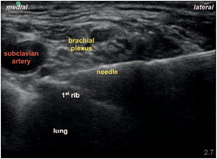 Échographie : Pointe de l’aiguille placée entre l’artère sous-clavière