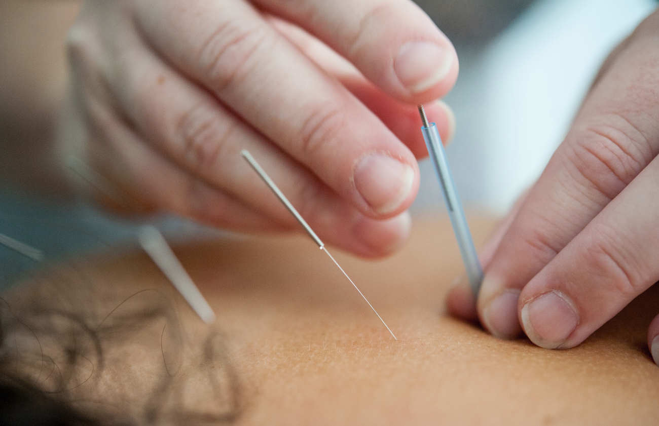 Séance d'acupuncture dans le dos