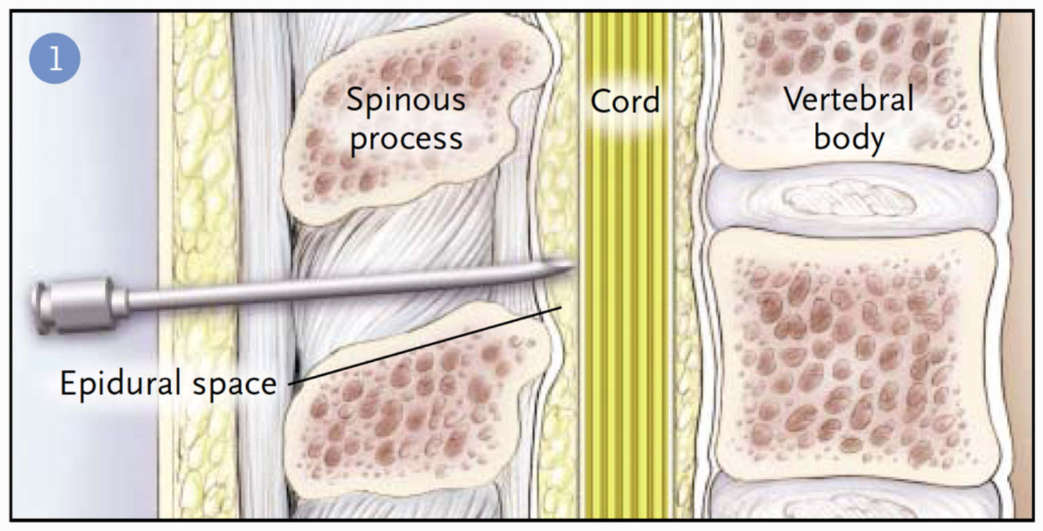 Espace péridural (anatomie) - Figure 1