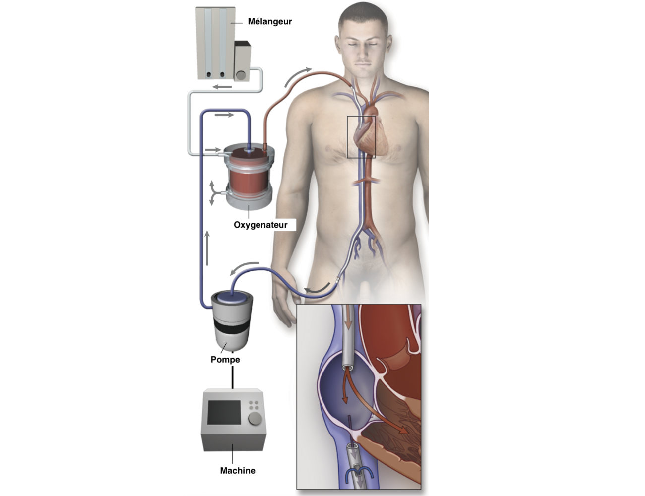 ECMO : fonctionnement sur un patient