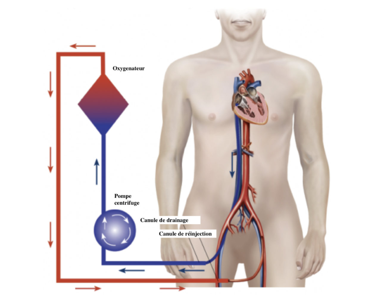 ECMO : comment ça marche ?