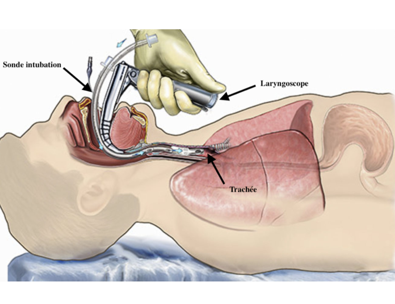 Intubation d'un patient