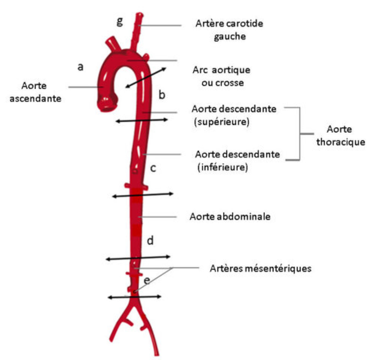 Maladie de l'aorte
