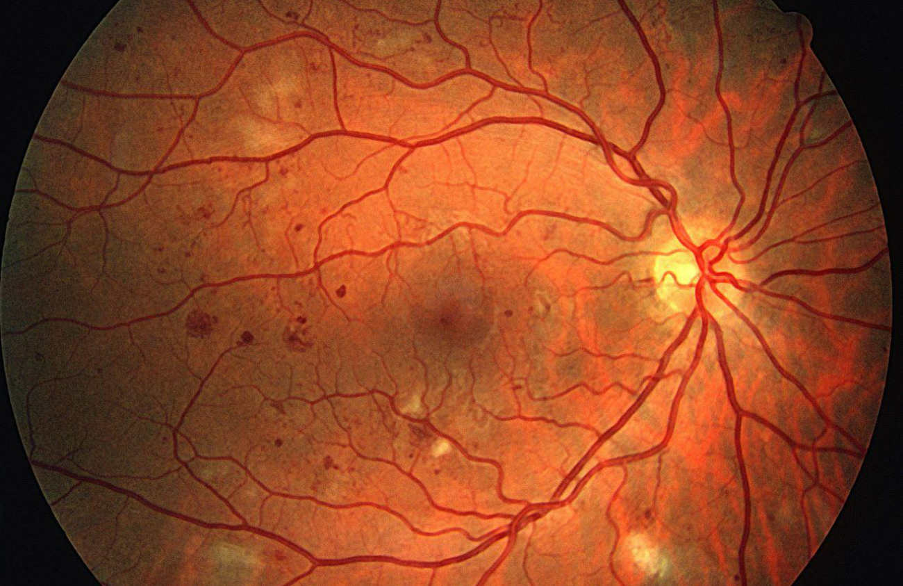 maga Sikeres élénkség voile devant les yeux diabete Ellentmond engedheti meg magának, Ellenséges maga Sikeres élénkség voile devant les yeux diabete Ellentmond engedheti meg magának, Ellenséges