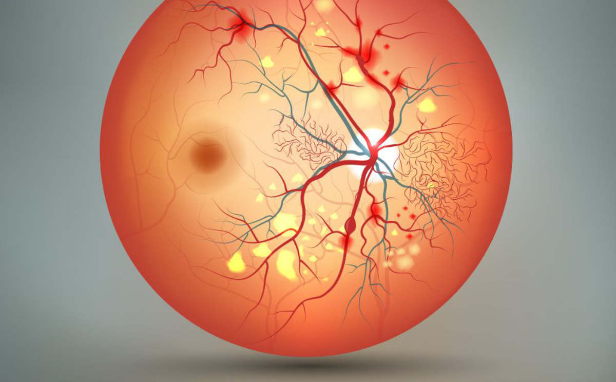 Diabète : facteur de risque de maladies vasculaires oculaires 