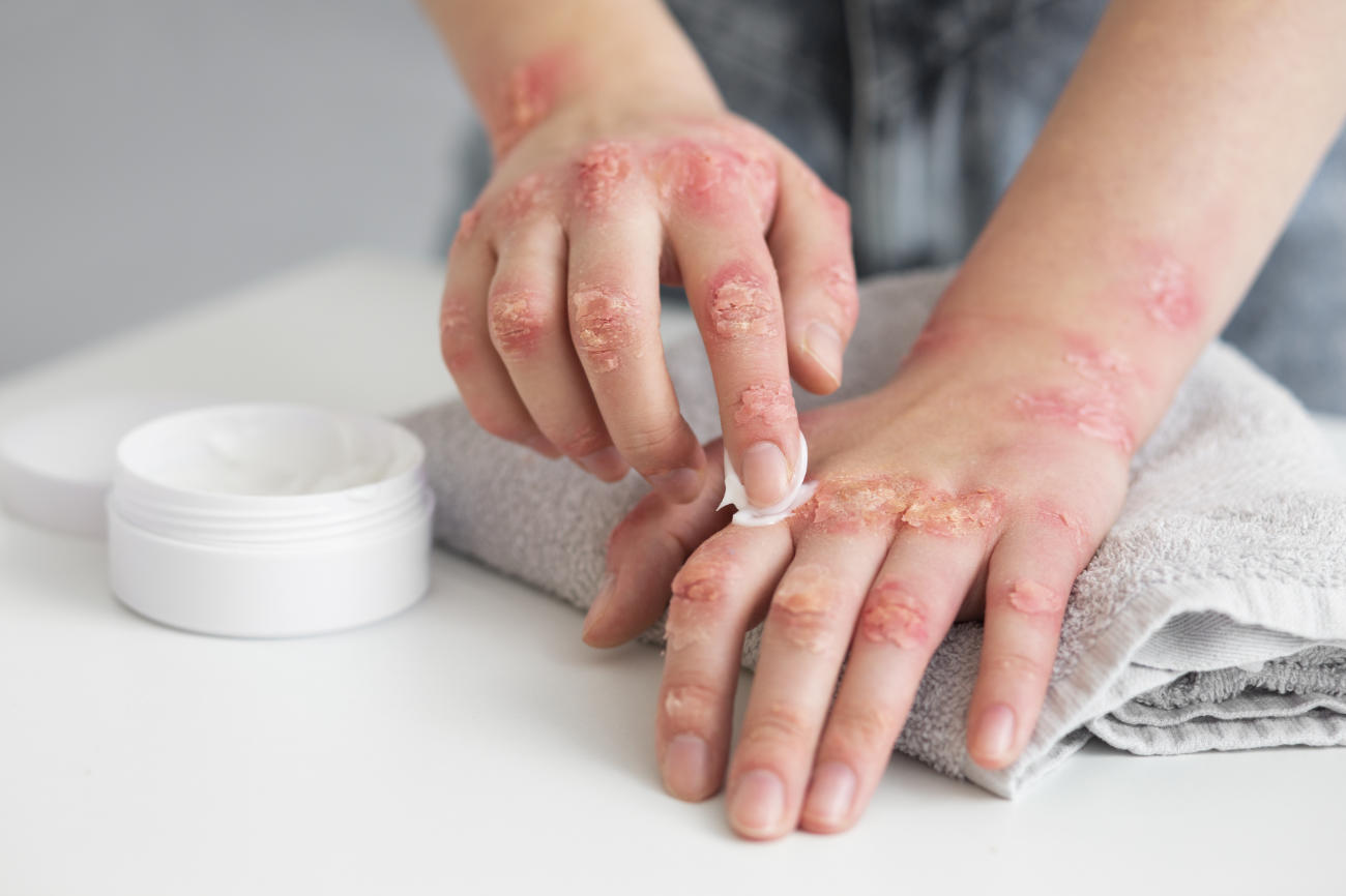 Psoriasis : tout savoir sur cette maladie inflammatoire chronique ...