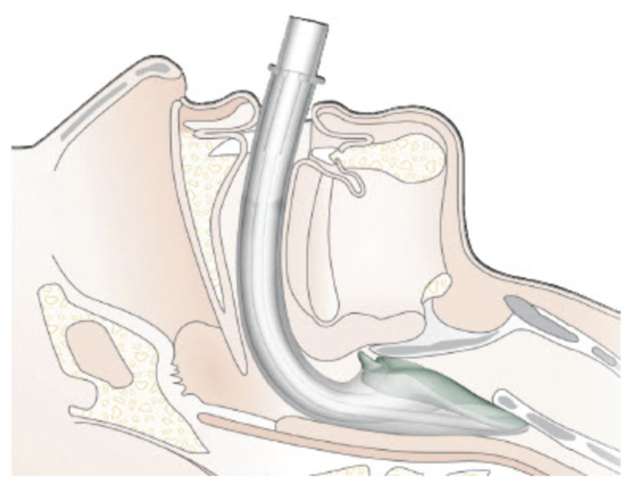 Sonde intubation en anesthésie