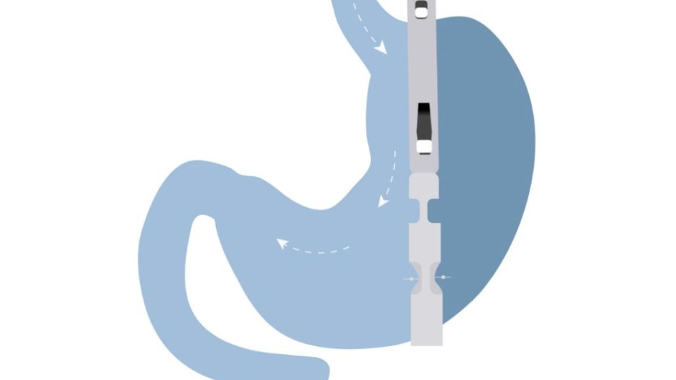 BariClip Innovative Solution Weight Loss Surgery