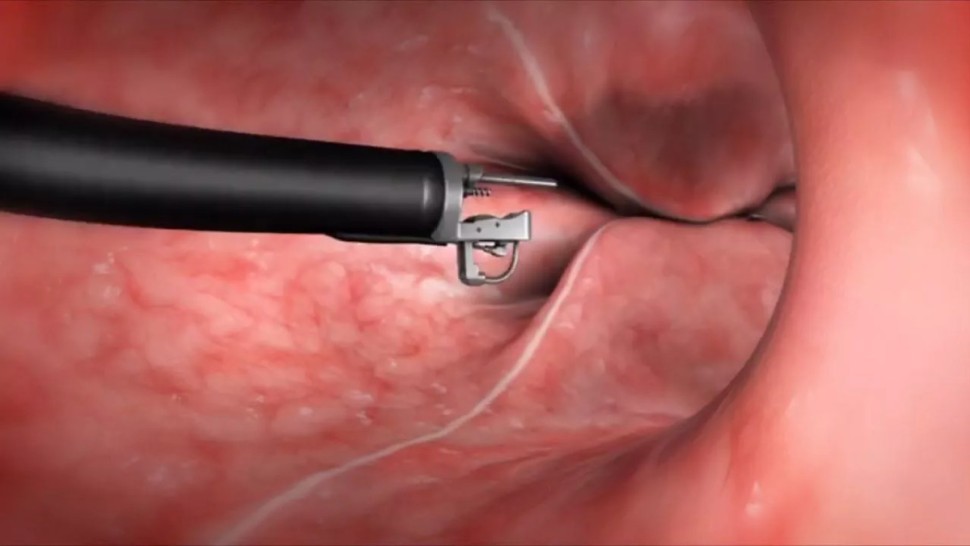 Endoscopic Sleeve Gastroplasty Quality Life