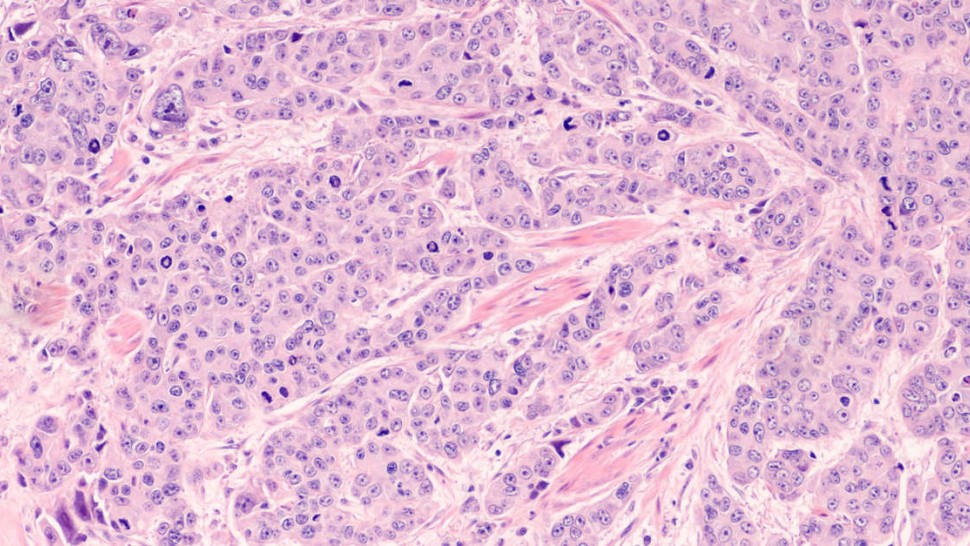 Photomicrographie de cancer urothélial de la vessie