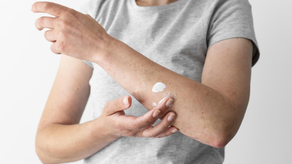 Patient infecté par une mycose