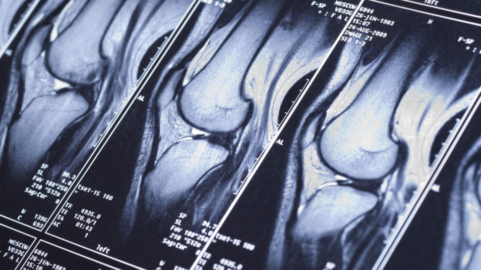 Radiographie reconstruction du ligament croisé antérieur