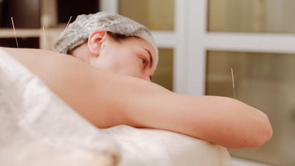 Femme en séance d'acupuncture