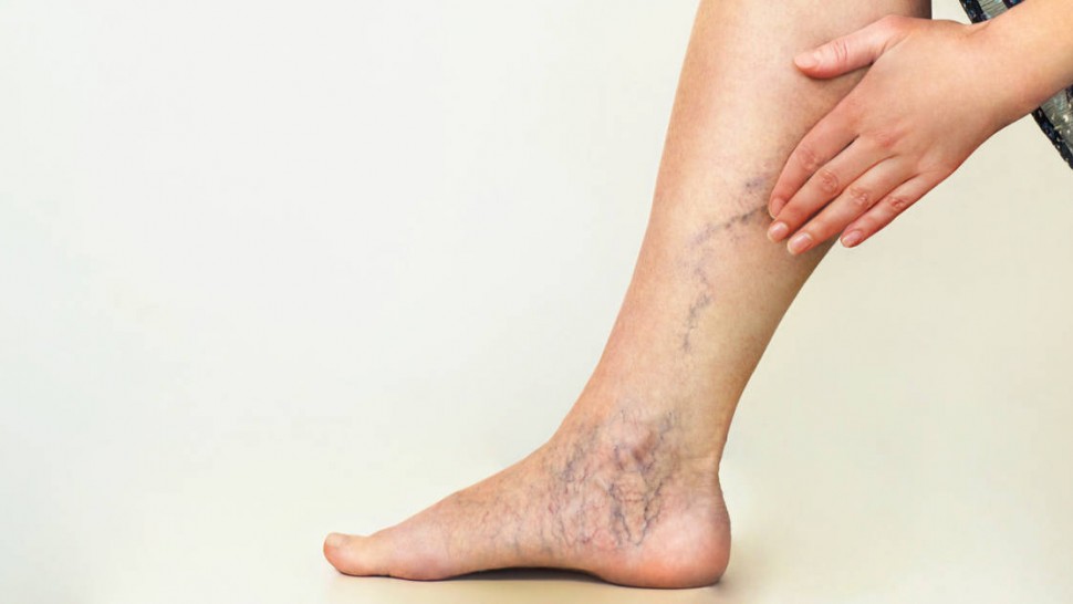 Varices : causes, risques et traitements