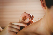 Une femme qui est se fait une séance d'acupuncture