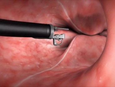 Endoscopic Sleeve Gastroplasty Quality Life 