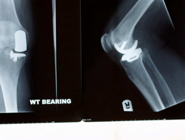 Photo d'une prothèse partielle de genou