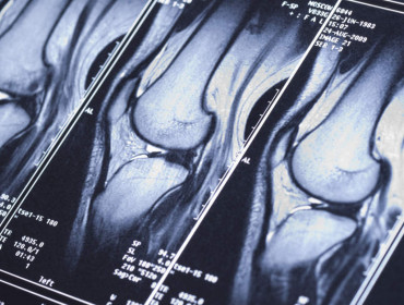 Radiographie reconstruction du ligament croisé antérieur