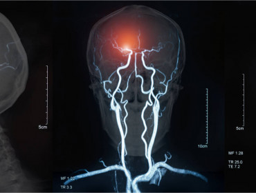 IRM des vaisseaux sanguins du cerveau 