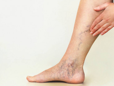 Varices : causes, risques et traitements