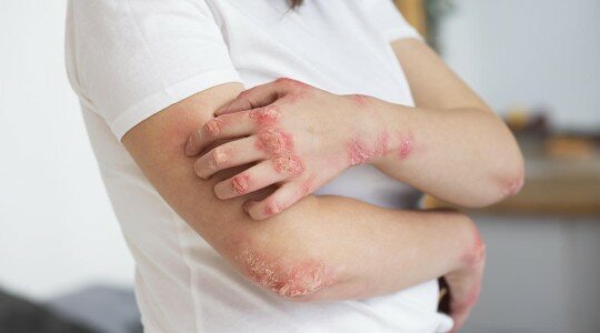 Patiente atteinte de psoriasis en plaques sur les avant-bras